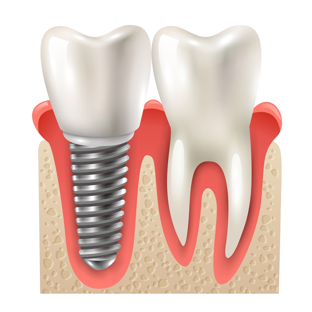 Dental Implants – Revolutionizing Teeth Replacement