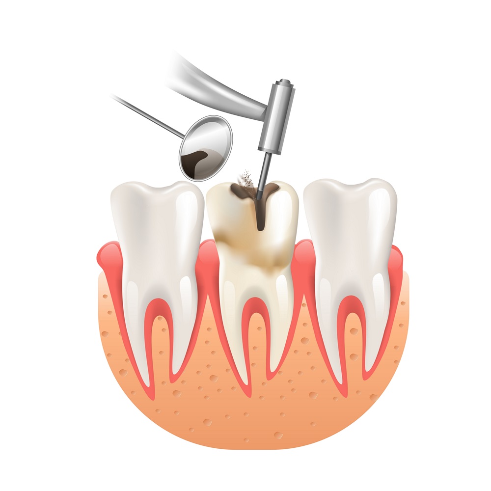 Root Canal Treatment – Saving Teeth, Relieving Pain