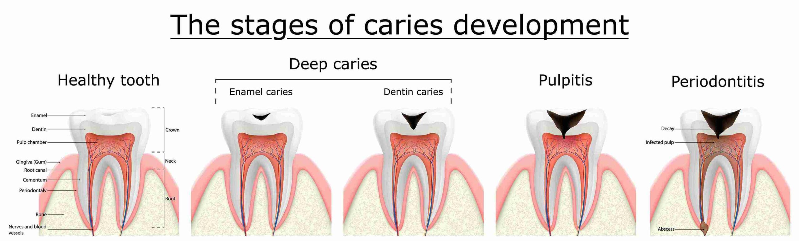 Root Canal Procedure