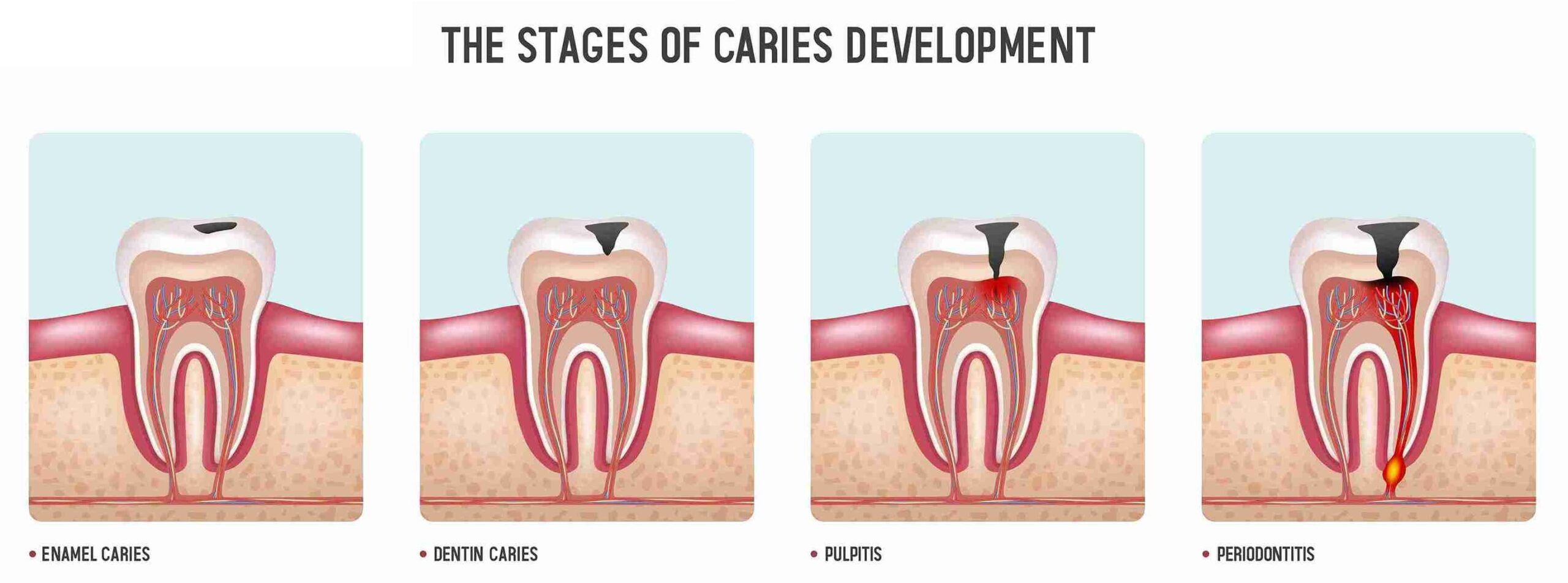 RCT procedure