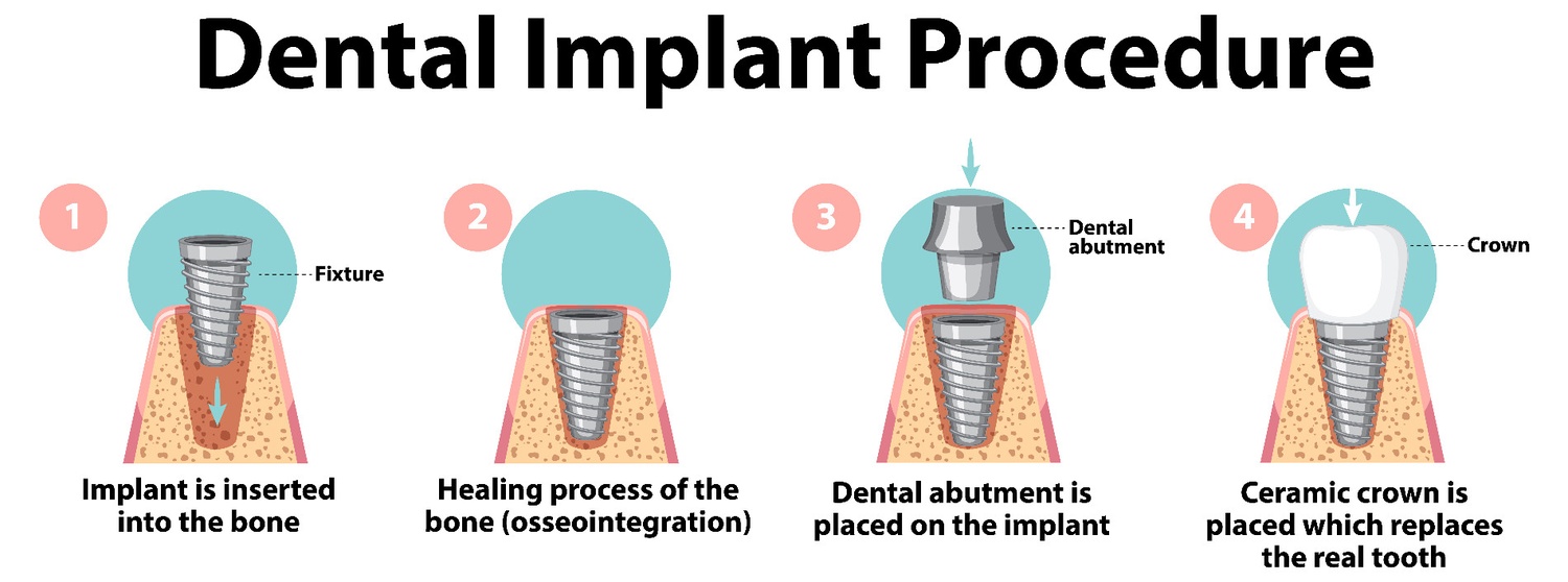 Dental Implant Procedure