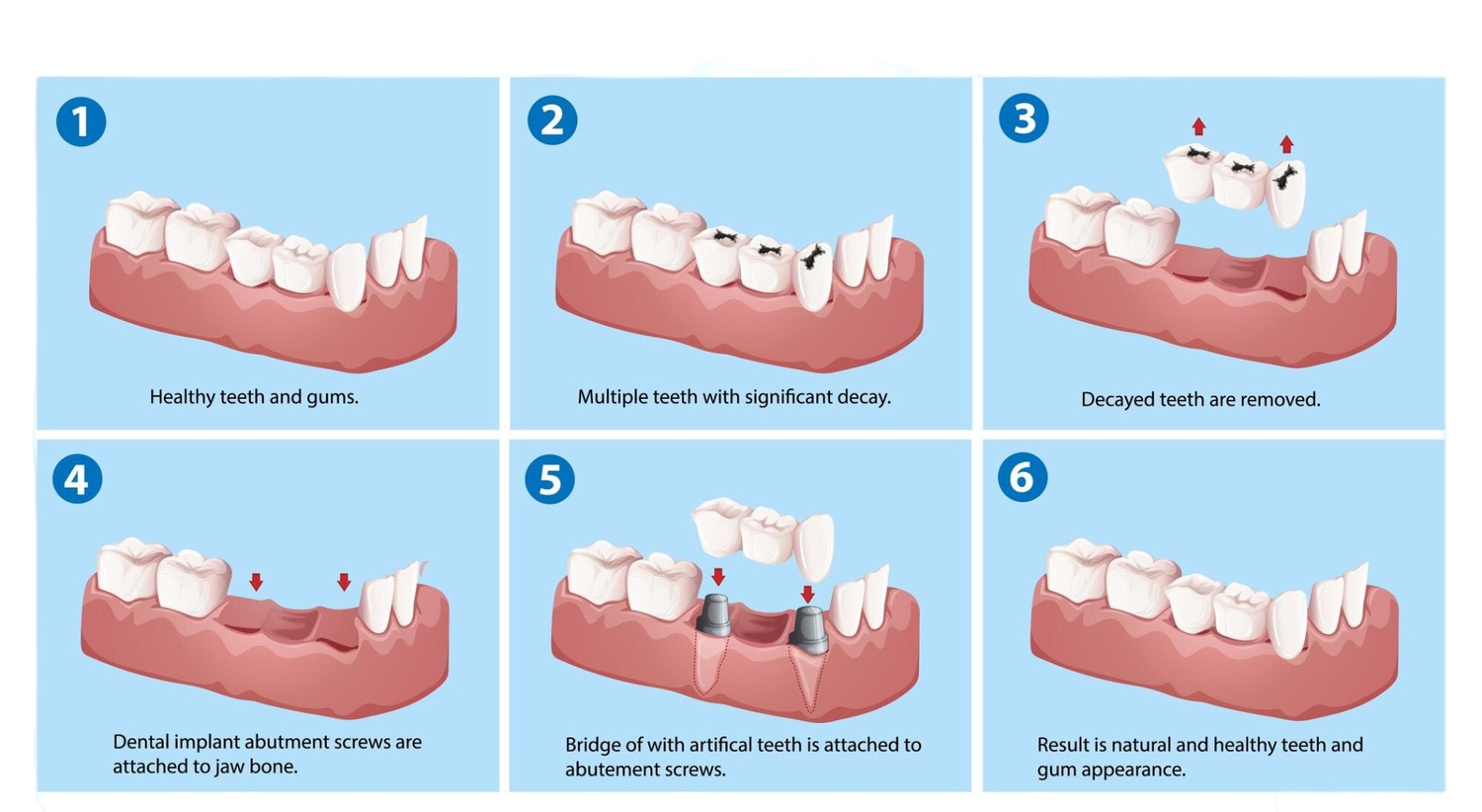 Dental Implant Crown Setting