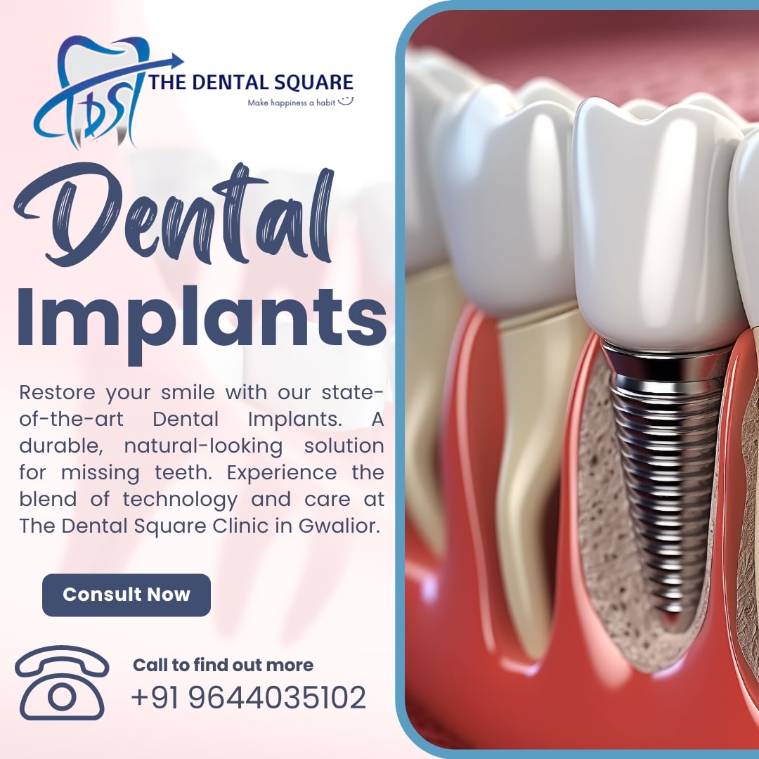 Dental Implants – Procedure, Importance, and Types by Dr. Sudhanshu Kushwah