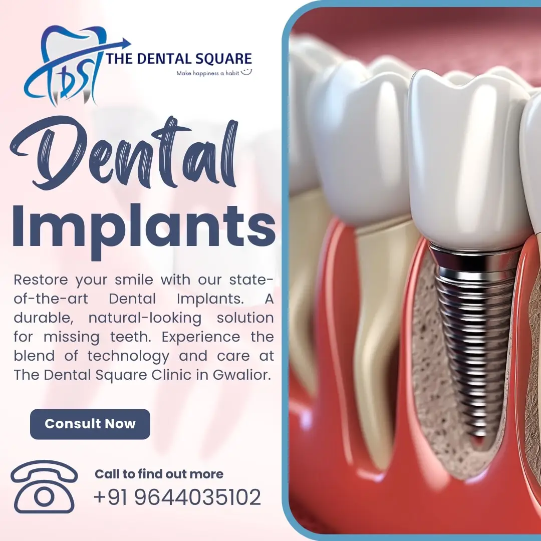Dental Implants – Procedure, Importance, and Types by Dr. Sudhanshu Kushwah