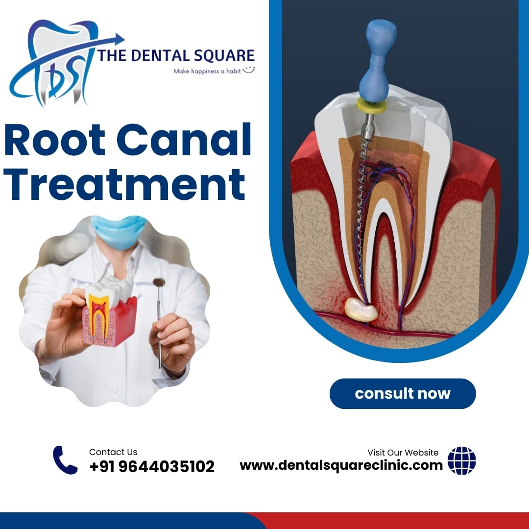 Root Canal Treatment – Procedure, Importance, and Types by Dr. Sudhanshu Kushwah