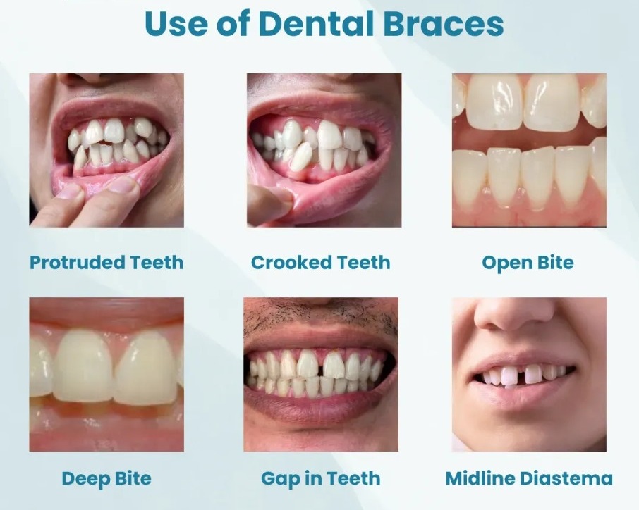 Use of Dental Braces